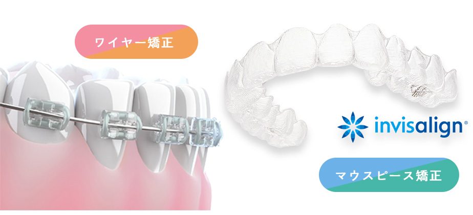 ワイヤー矯正、マウスピース