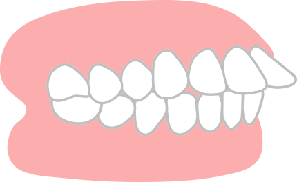 前歯が出ている