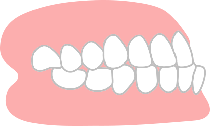 下あごがでている