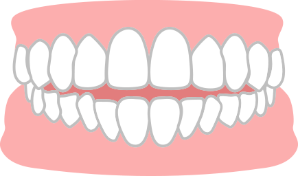 前歯が噛み合わない